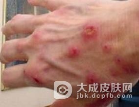 预防疥疮的四大方法介绍
