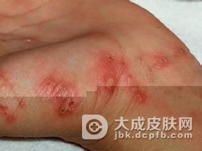身体瘙痒是患了疥疮吗