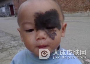 使胎记形成的因素究竟有哪些