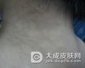 花斑癣的预防方法有哪些