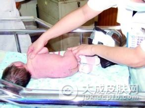生活中脓疱型牛皮癣的病因是什么