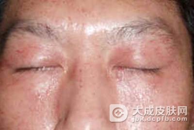 异位性皮炎怎么治疗