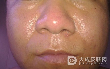 是什么原因引起异位性皮炎
