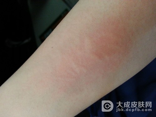 异位性皮炎的治疗措施有哪些呢