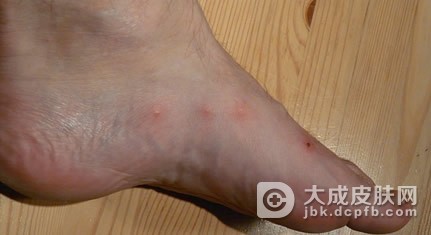 引发异位性皮炎的原因