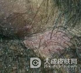 男性阴虱病患者常见病因