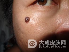 引发黑色素痣的原因是什么