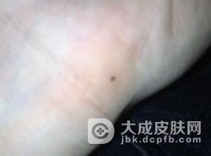 形成色素痣的原因是什么