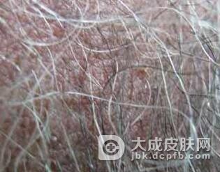 阴虱病是怎么引起的呢
