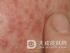 隐翅虫皮炎的发病特点有哪些