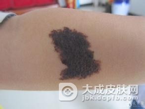 黑色素痣采用激光治疗效果如何