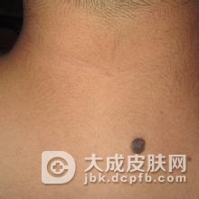 黑色素细胞痣如何治疗