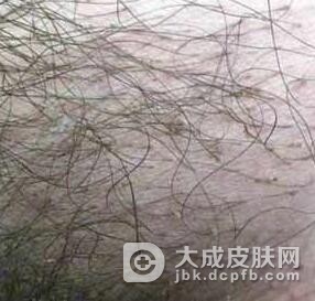 阴虱病是怎样发生传染的呢?