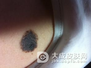 色素痣恶变会有什么症状
