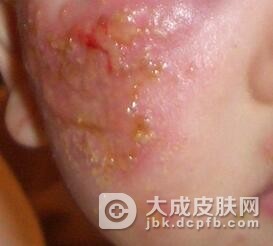 脓包疮怎么治疗呢