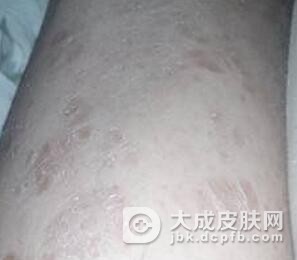 怎么预防副银屑病