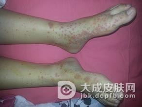 皮肤血管炎的症状表现是什么
