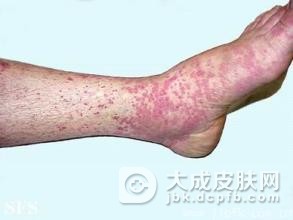 变应性皮肤血管炎的概述有什么