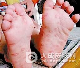 如何预防儿童手足口病