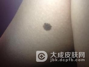 如何区分痣与黑色素瘤