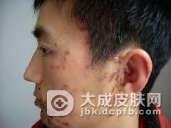 耳带状疱疹的症状及危害
