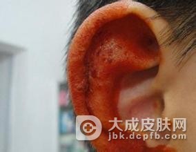 生活中的耳部带状疱疹有哪些表现