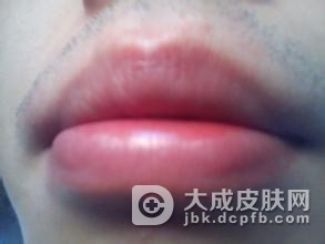 如何防止剥脱性唇炎的发生