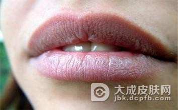 剥脱性唇炎主要的病发因素有什么