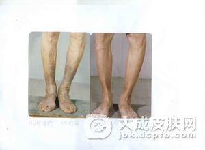 扁平苔癣容易与哪些症状混淆