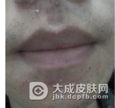 额头粉刺的护理