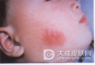 单纯疱疹病毒主要的传播方式有哪些
