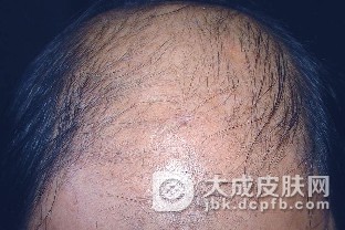 斑秃病人在平时中的需要加以注意