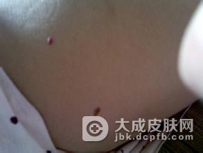 什么原因可导致鲜红斑痣