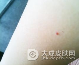 出现鲜红斑痣的原因是什么