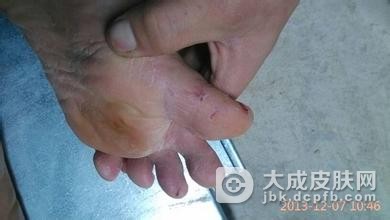 手足癣的根本知识都有哪些呢
