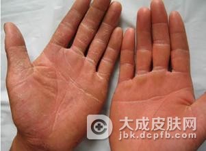 治疗手足癣的时候要注意什么呢