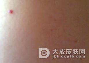 婴儿鲜红斑痣有什么症状