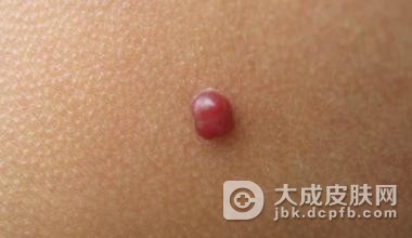 怎样有效预防鲜红斑痣