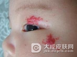 鲜红斑痣的危害主要有什么
