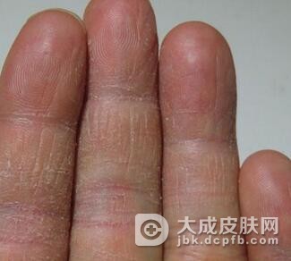 手癣会给我们带来哪些影响