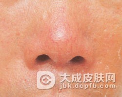 酒渣鼻有什么治疗方法