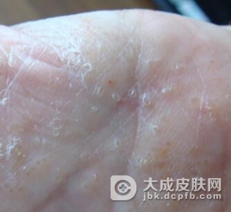 应该如何预防手癣呢?