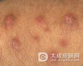 急性单纯性痒疹症状表现