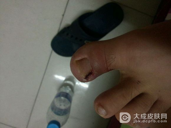治疗甲沟炎需要多少钱呢