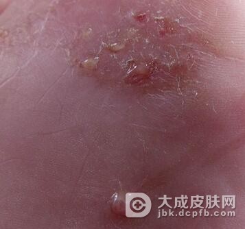 脚癣都有哪些症状呢?