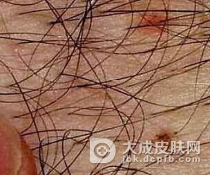 如何自行诊断阴虱病