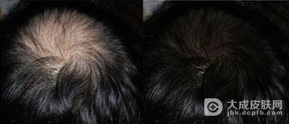 专家介绍七种诱发女性脱发的因素