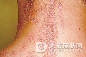 自体敏感性皮炎的发生原因有什么