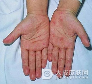 常见梅毒疹的类型有哪些？