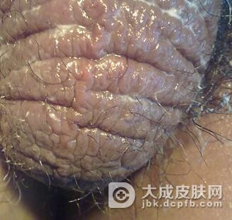 阴囊湿疹发生原因有哪些?